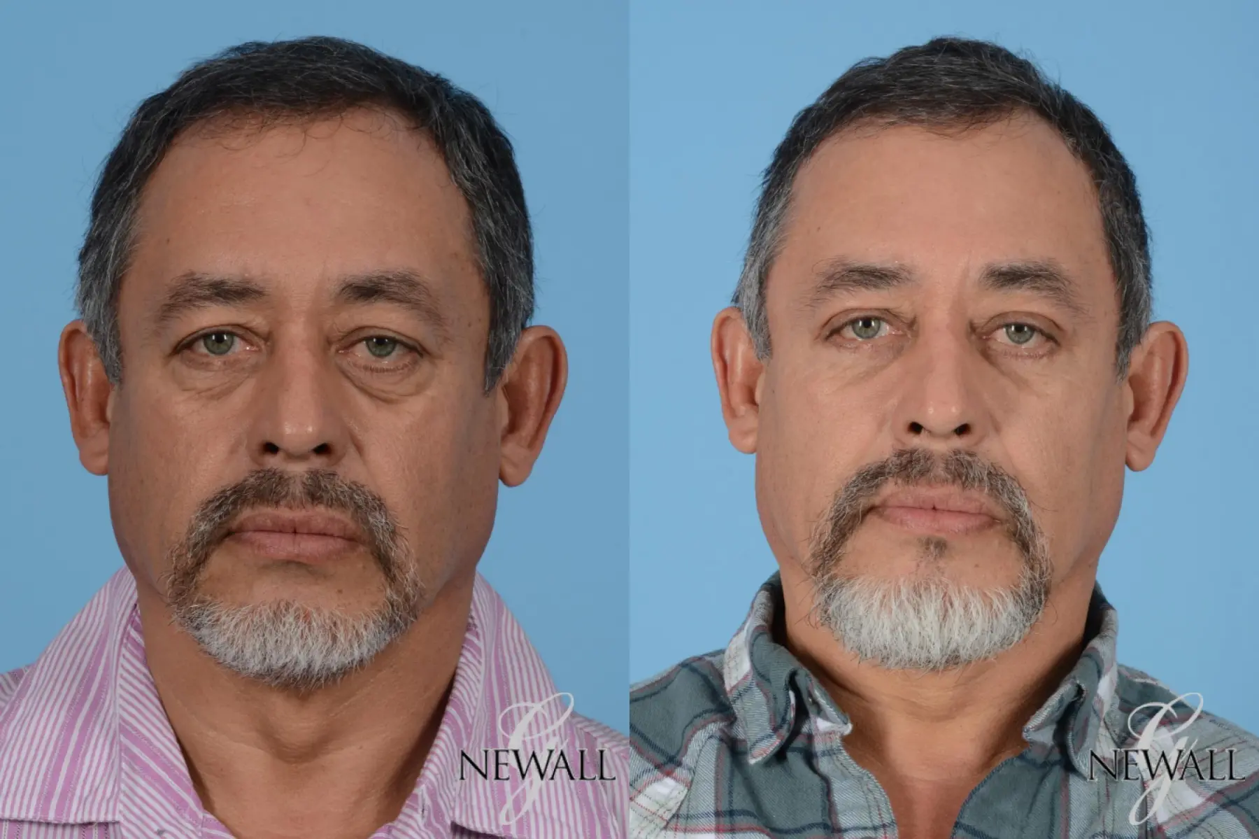 Fat-transfer---face-for-men: Patient 1 - Before and After  