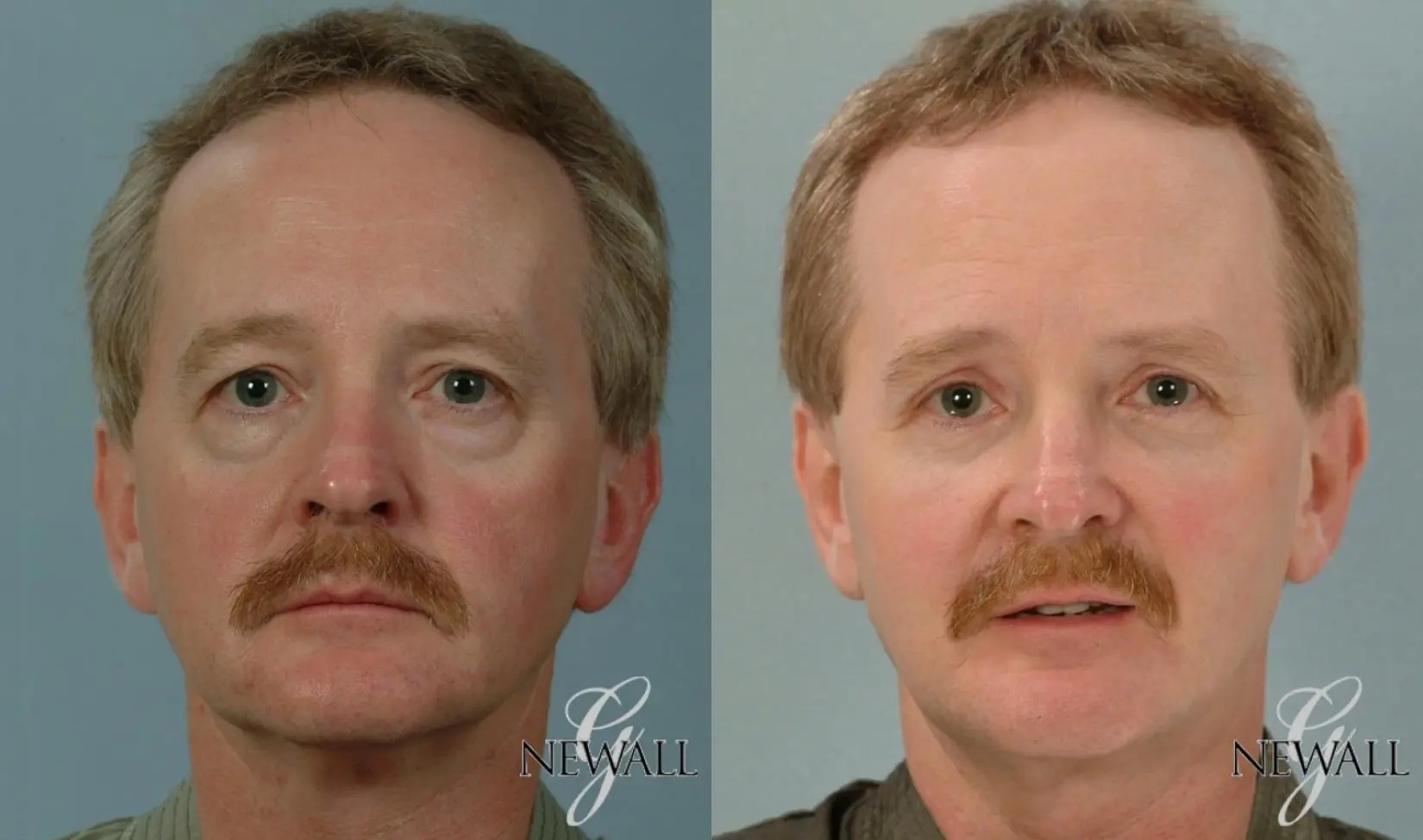 Fat-transfer---face-for-men: Patient 2 - Before and After  