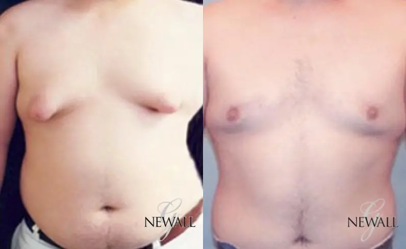 Gynecomastia: Patient 2 - Before and After  