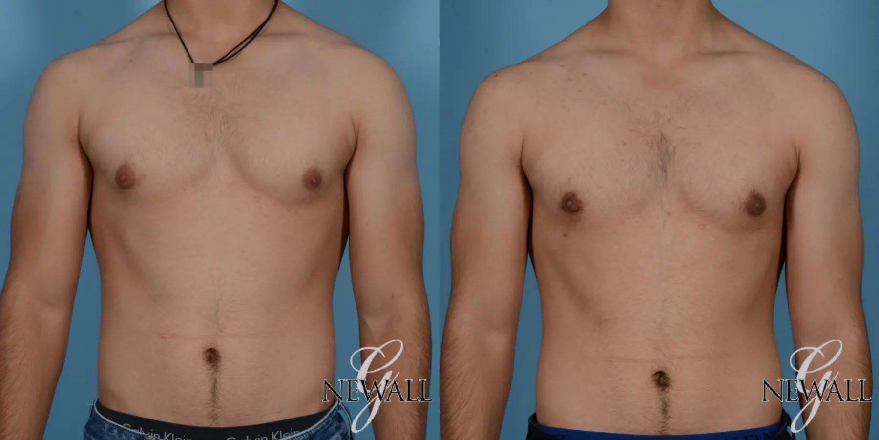 Gynecomastia: Patient 1 - Before and After  