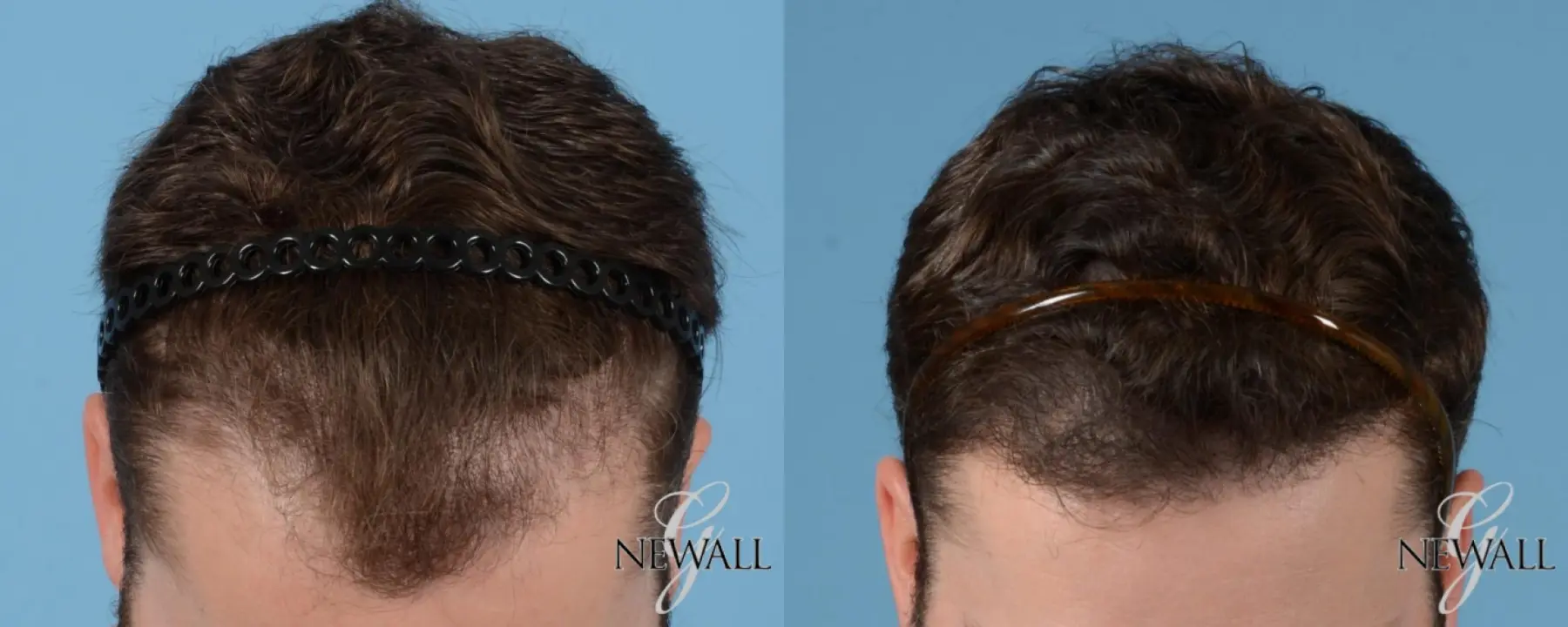 Hair-transplantation-for-men: Patient 1 - Before and After  