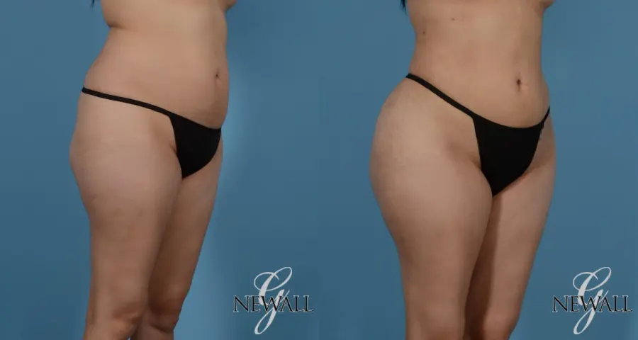 Liposuction: Patient 1 - Before and After 2