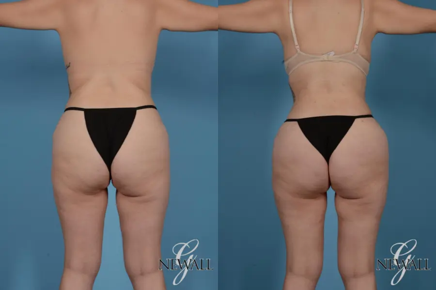 Liposuction: Patient 7 - Before and After 4