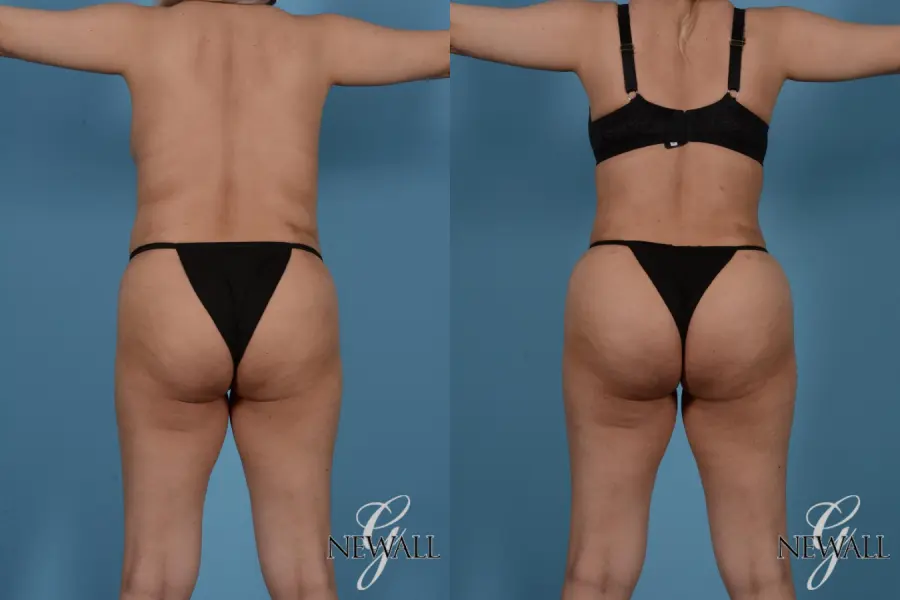 Liposuction: Patient 5 - Before and After 4