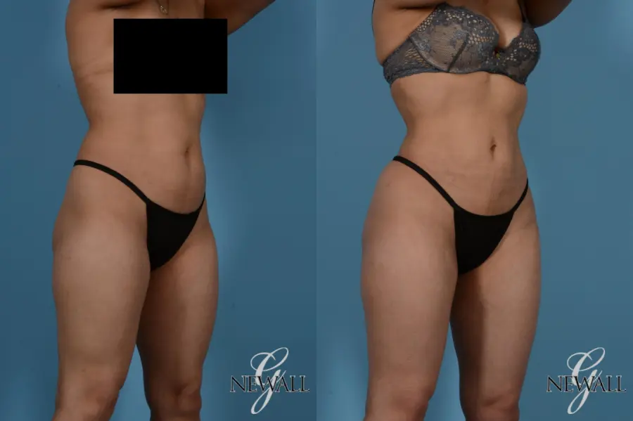 Liposuction: Patient 8 - Before and After 2