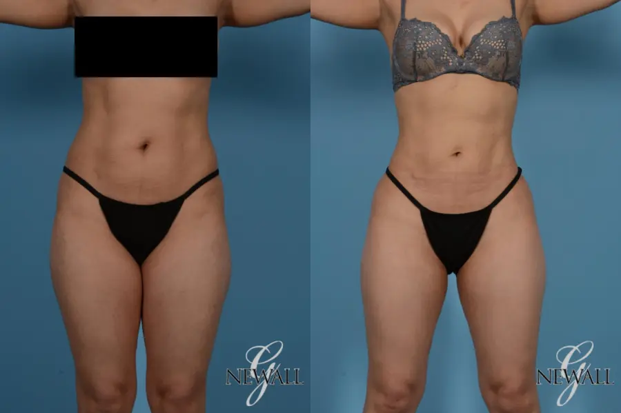 Liposuction: Patient 8 - Before and After  