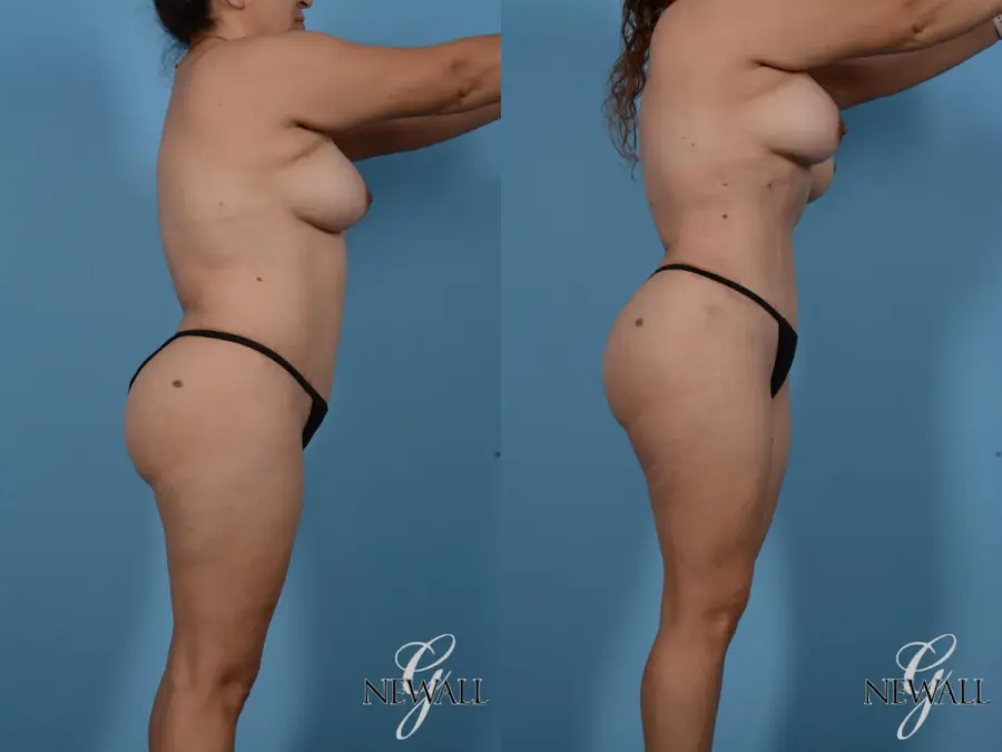 Liposuction: Patient 3 - Before and After 2