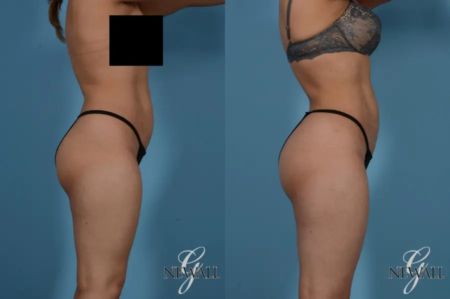 Liposuction: Patient 8 - Before and After 3