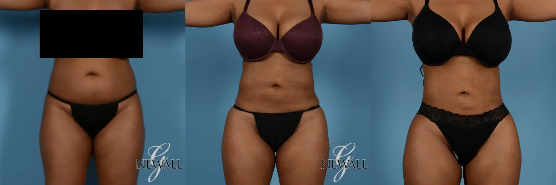 Liposuction: Patient 4 - Before and After  