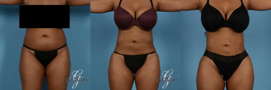 Liposuction: Patient 4 - Before and After 1