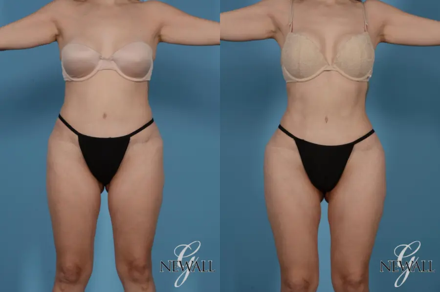 Liposuction: Patient 7 - Before and After  
