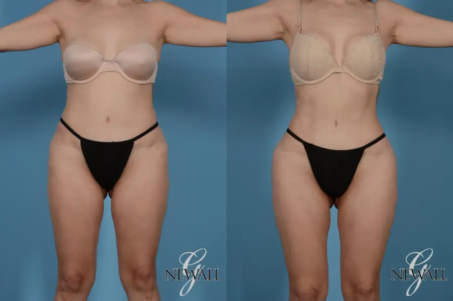 Liposuction: Patient 7 - Before and After 1