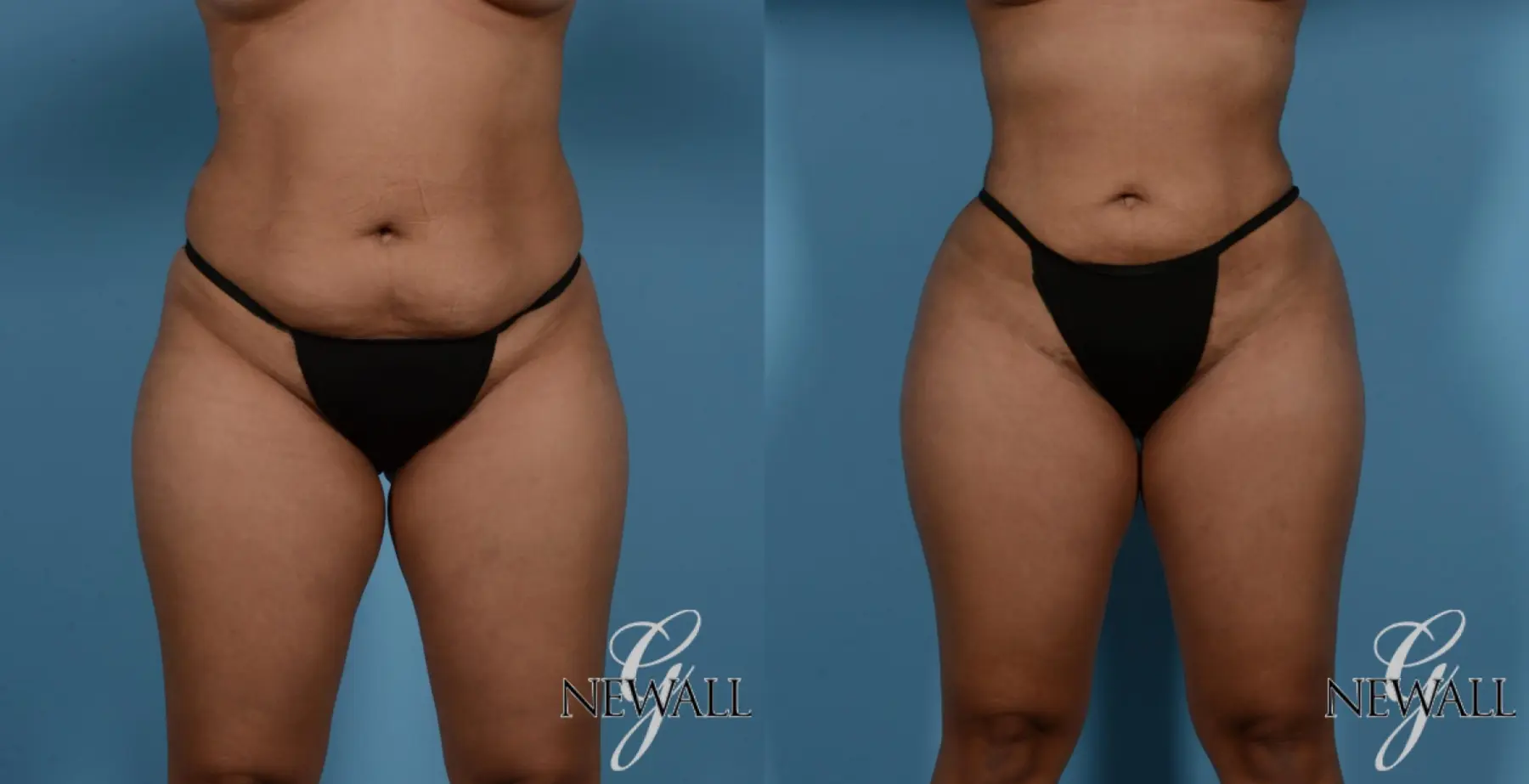 Liposuction: Patient 2 - Before and After  