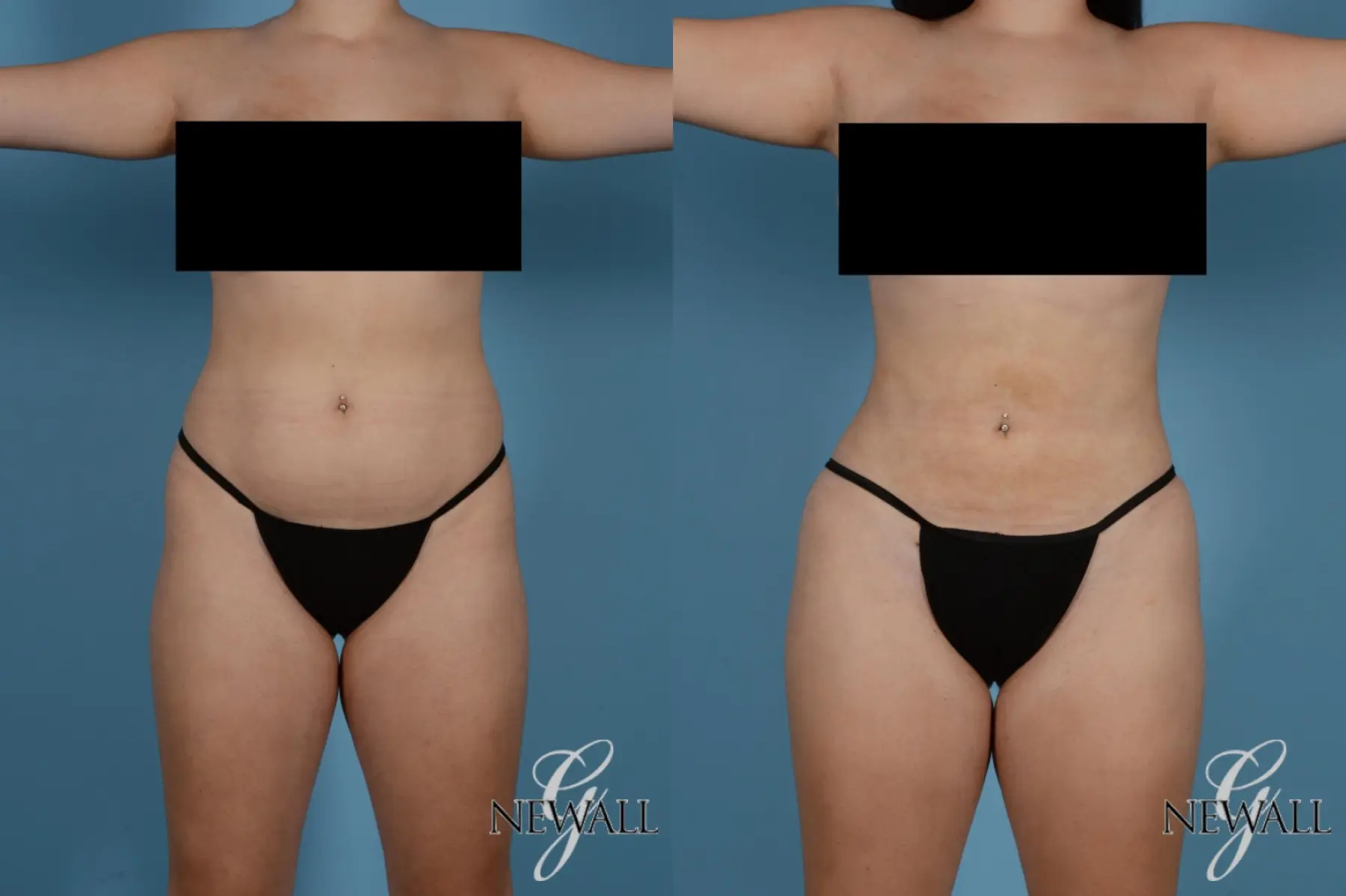 Liposuction: Patient 9 - Before and After  