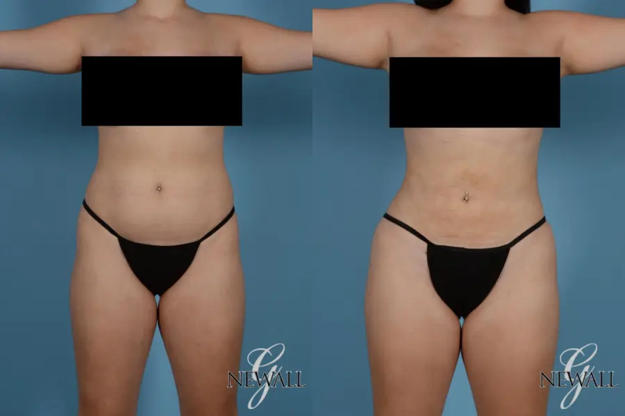 Liposuction: Patient 9 - Before and After 1