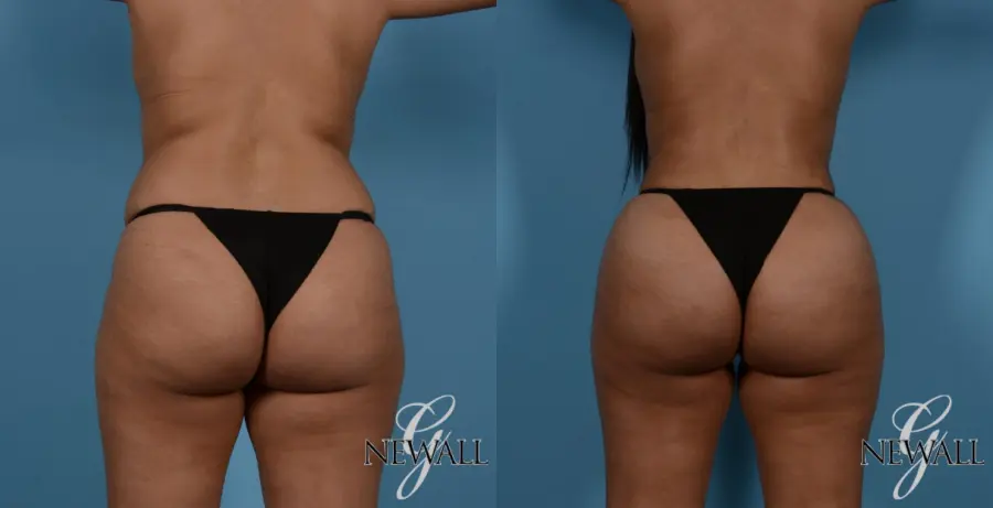 Liposuction: Patient 2 - Before and After 2
