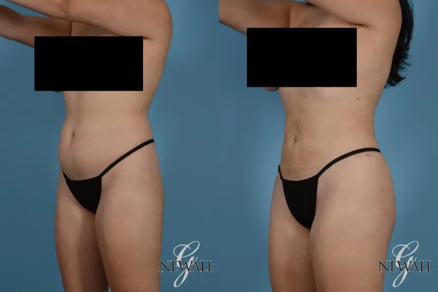 Liposuction: Patient 9 - Before and After 3