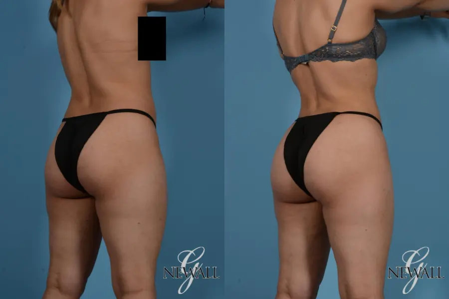 Liposuction: Patient 8 - Before and After 4