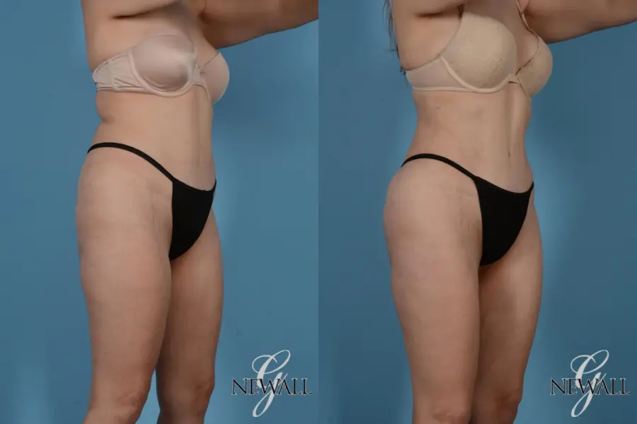 Liposuction: Patient 7 - Before and After 2