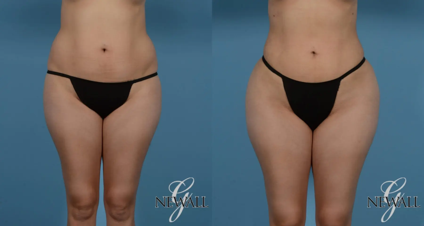 Liposuction: Patient 1 - Before and After  