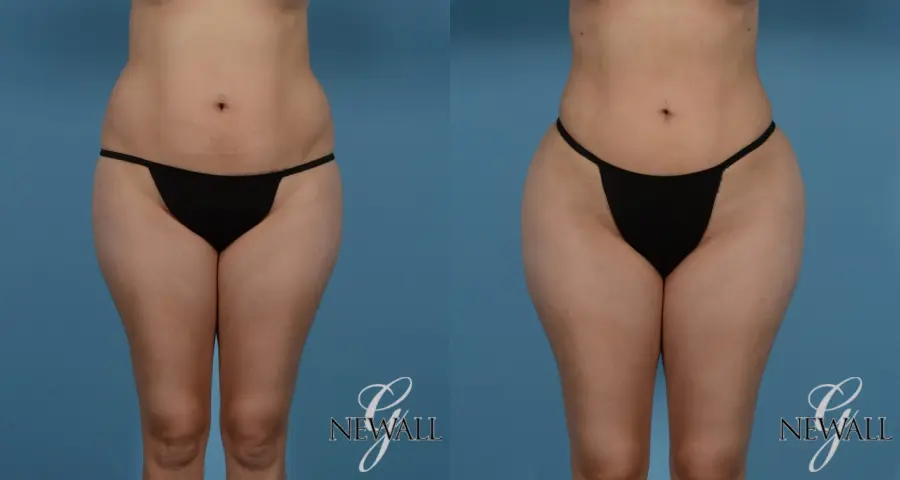 Liposuction: Patient 1 - Before and After 1