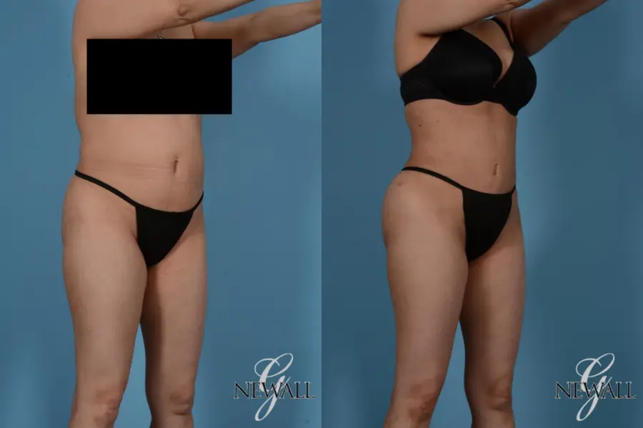 Liposuction: Patient 5 - Before and After 2