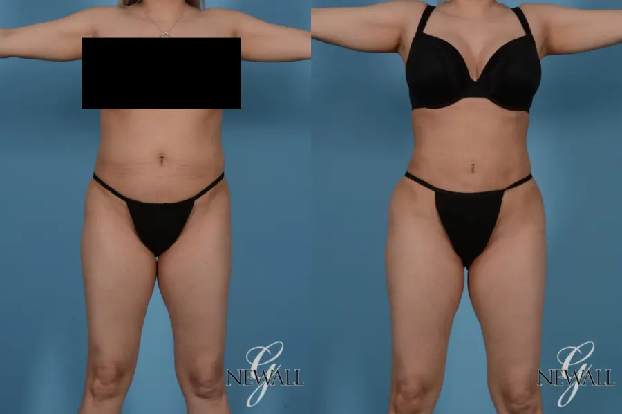 Liposuction: Patient 5 - Before and After  