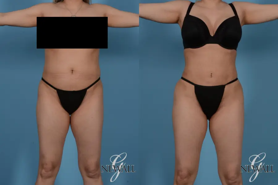 Liposuction: Patient 5 - Before and After 1