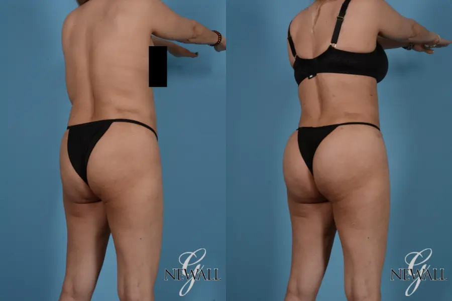 Liposuction: Patient 5 - Before and After 5