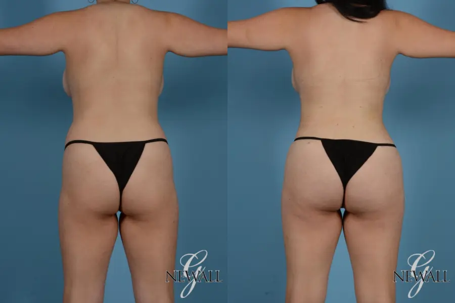 Liposuction: Patient 9 - Before and After 5