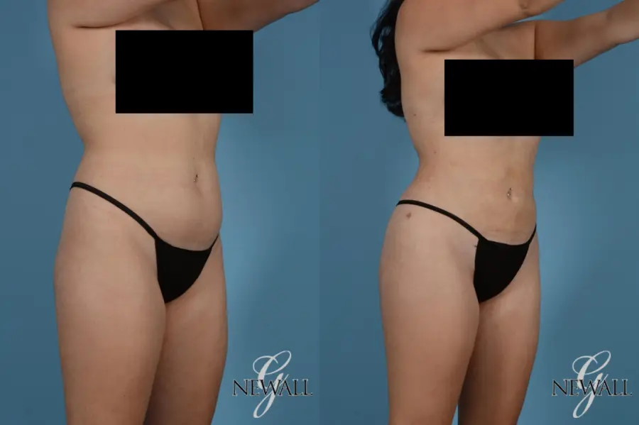 Liposuction: Patient 9 - Before and After 2