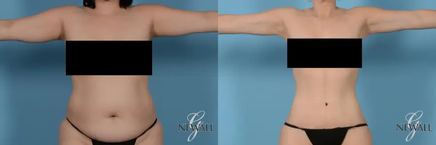 Liposuction: Patient 6 - Before and After 1