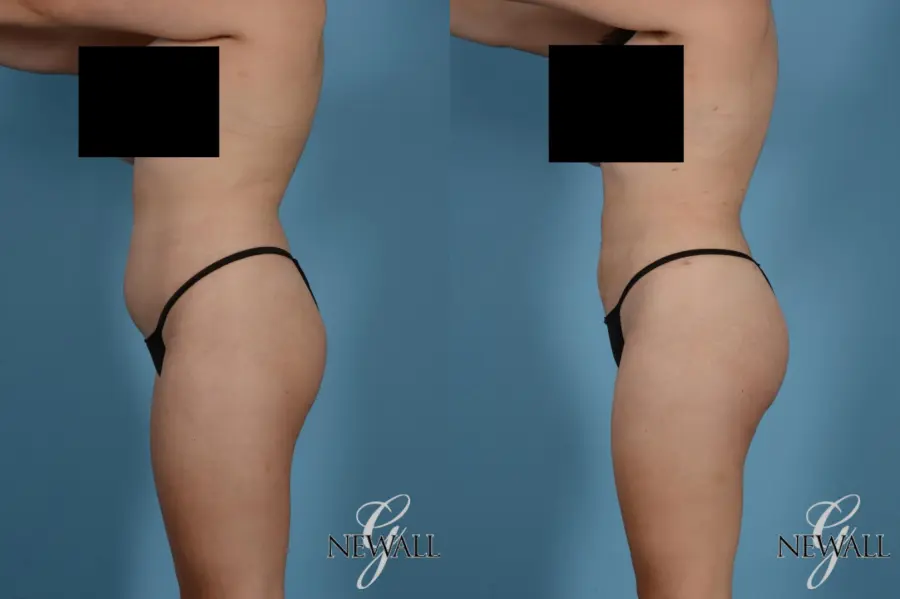 Liposuction: Patient 9 - Before and After 4