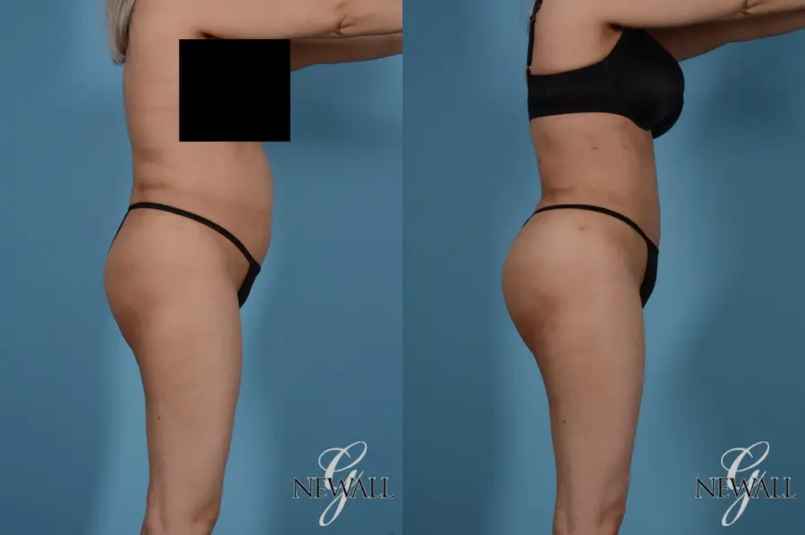Liposuction: Patient 5 - Before and After 3