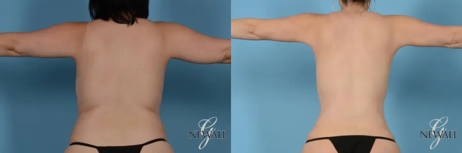 Liposuction: Patient 6 - Before and After 2