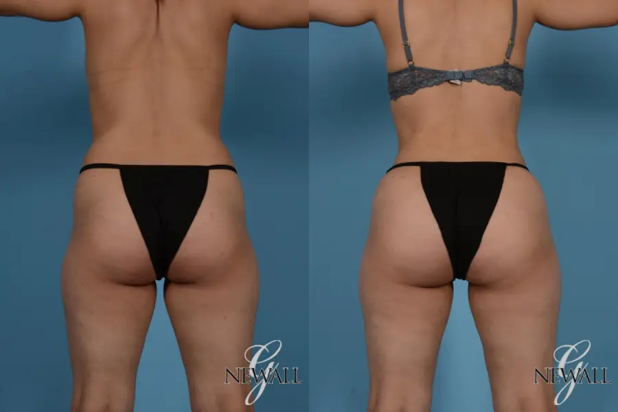 Liposuction: Patient 8 - Before and After 5