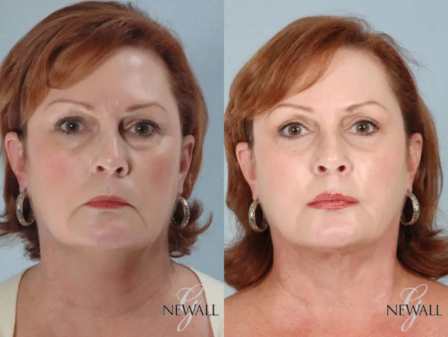 Liposuction Of The Neck: Patient 2 - Before and After  
