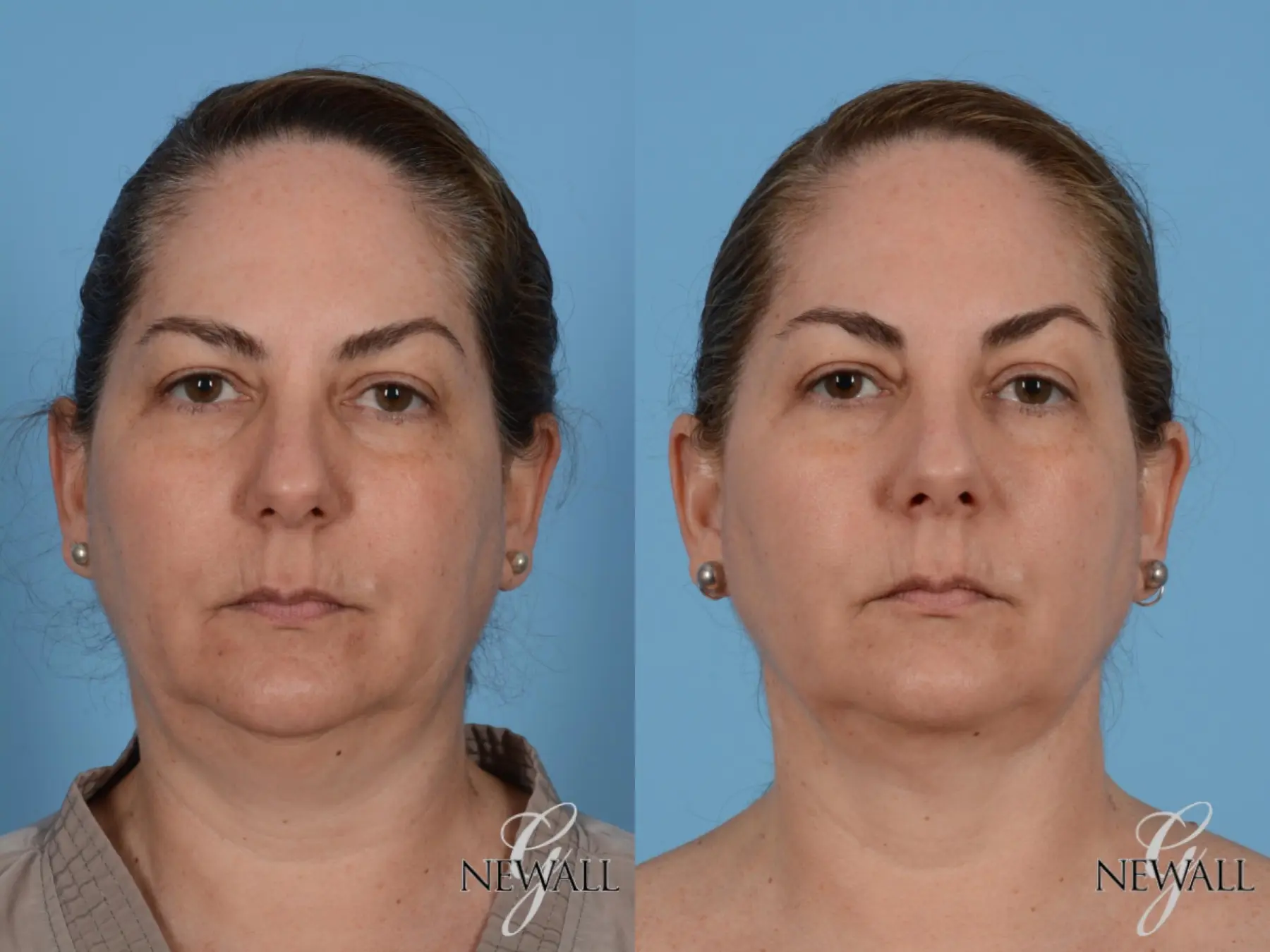 Liposuction Of The Neck: Patient 3 - Before and After  