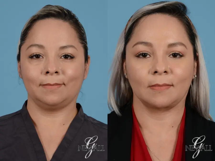 Liposuction Of The Neck: Patient 1 - Before and After  