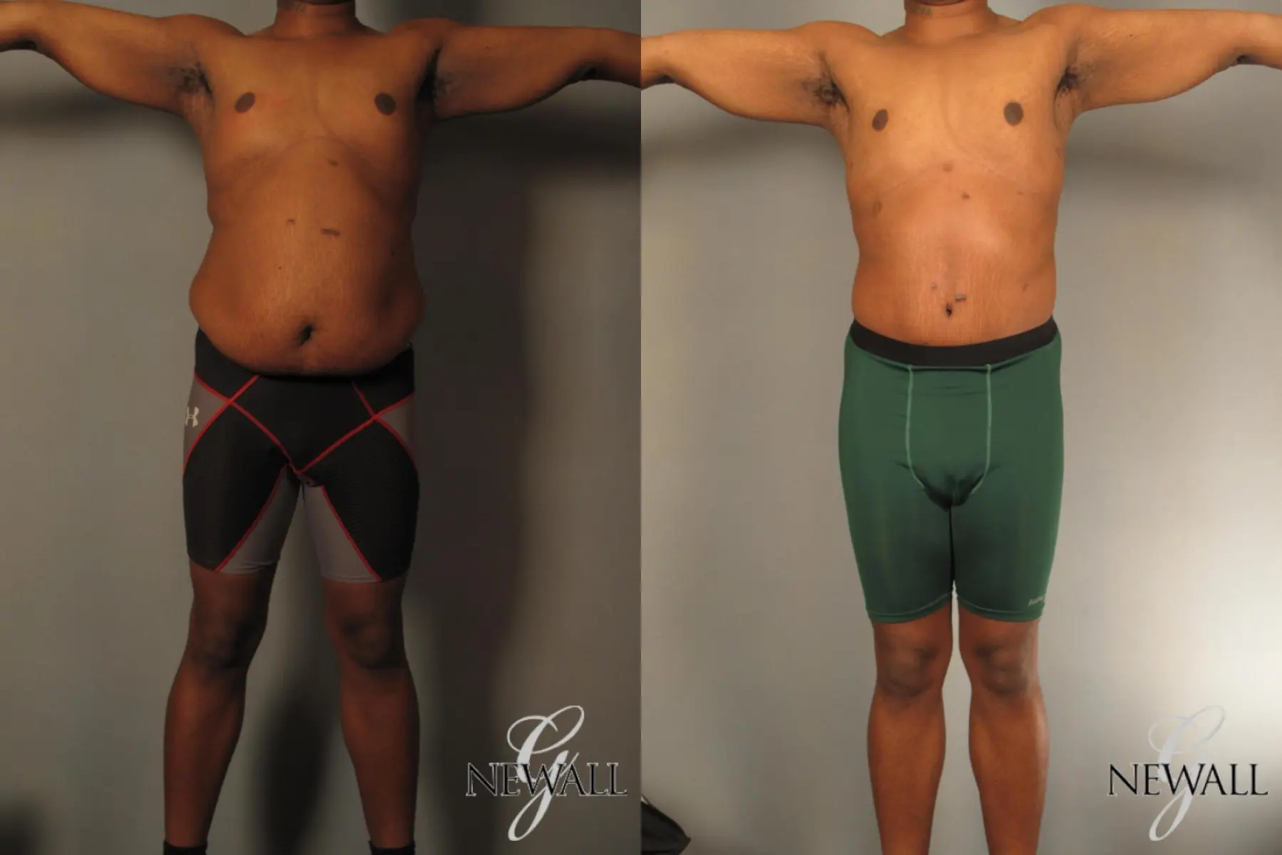 Male-tummy-tuck-for-men: Patient 1 - Before and After  
