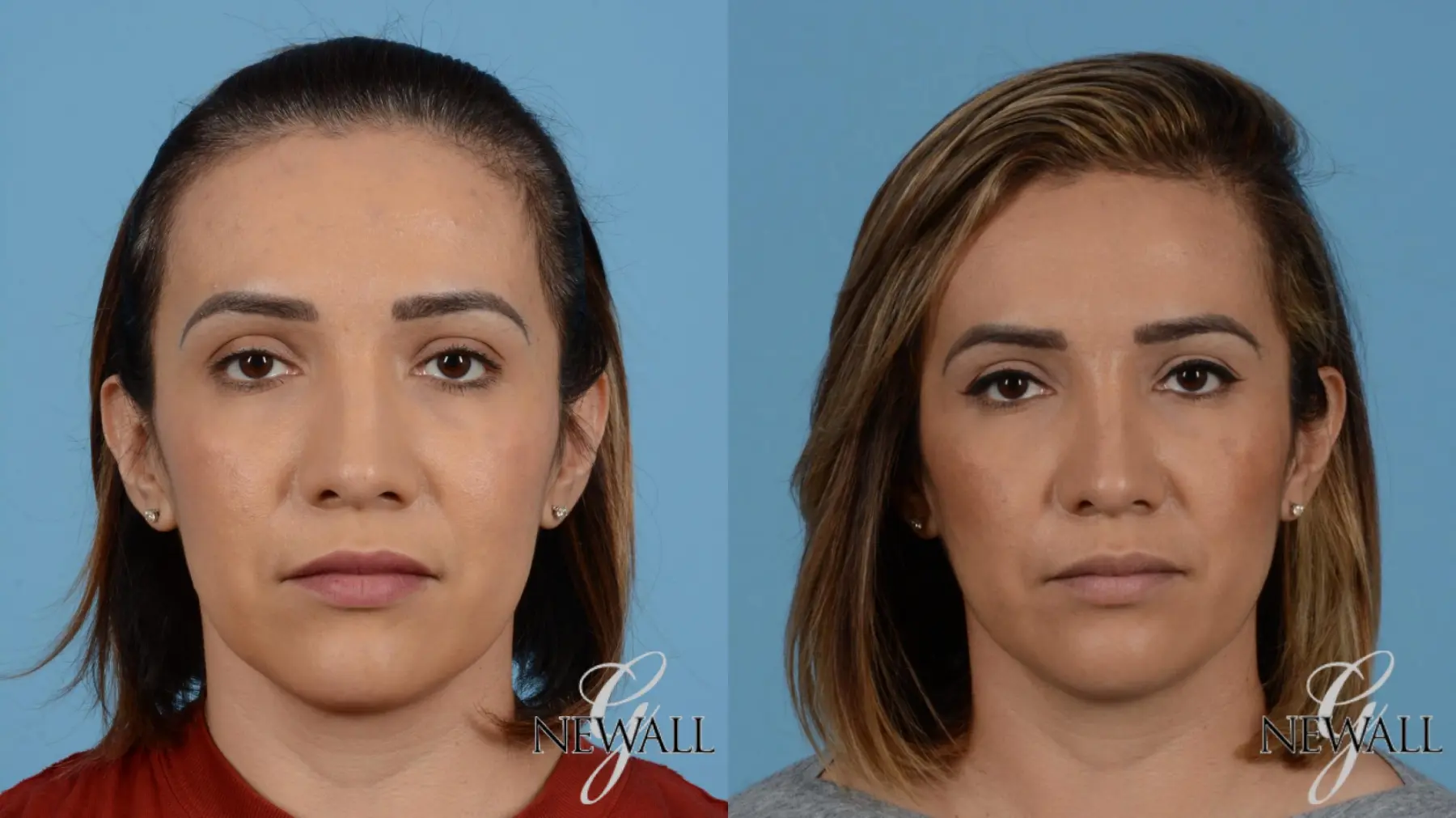 Rhinoplasty: Patient 1 - Before and After  