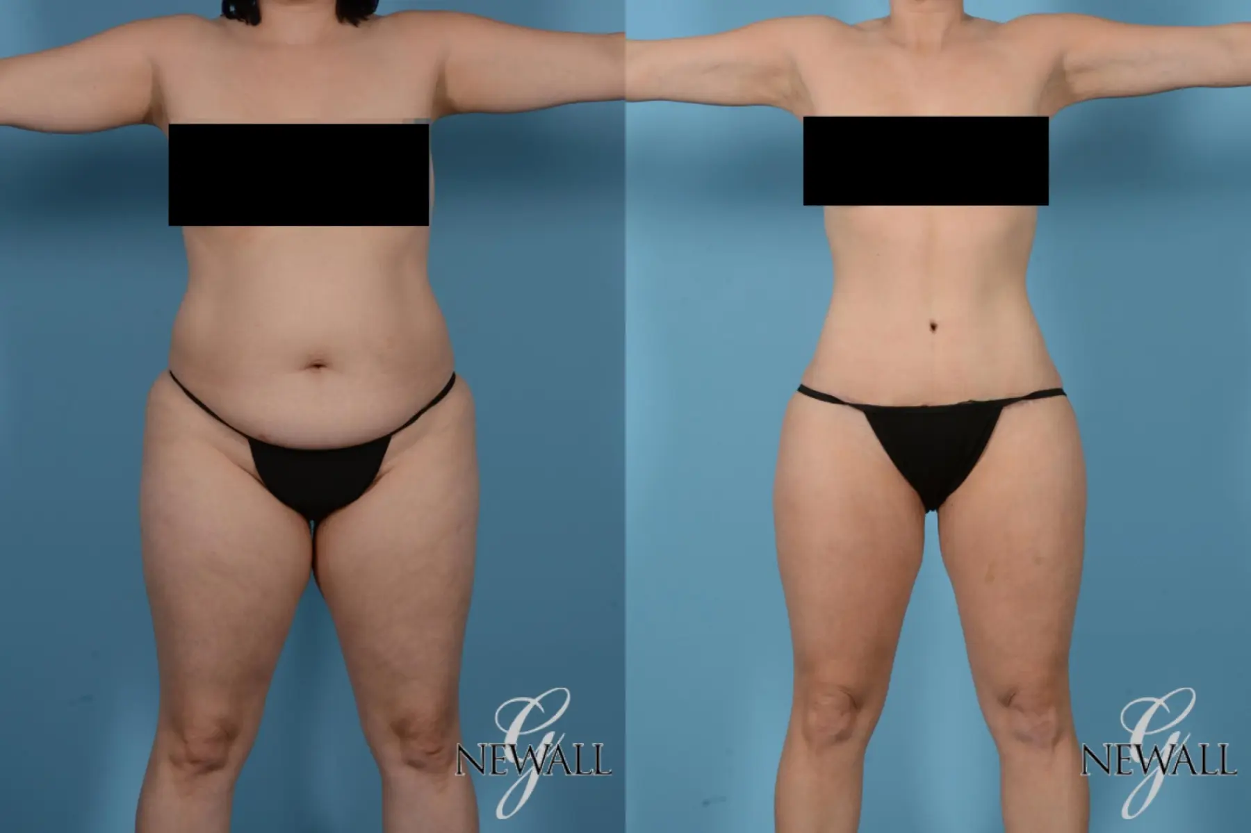 Tummy Tuck: Patient 12 - Before and After  