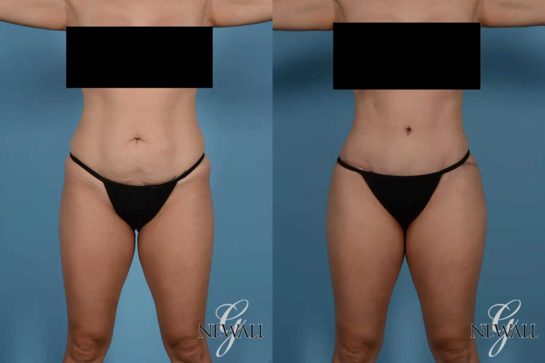 Tummy Tuck: Patient 14 - Before and After  