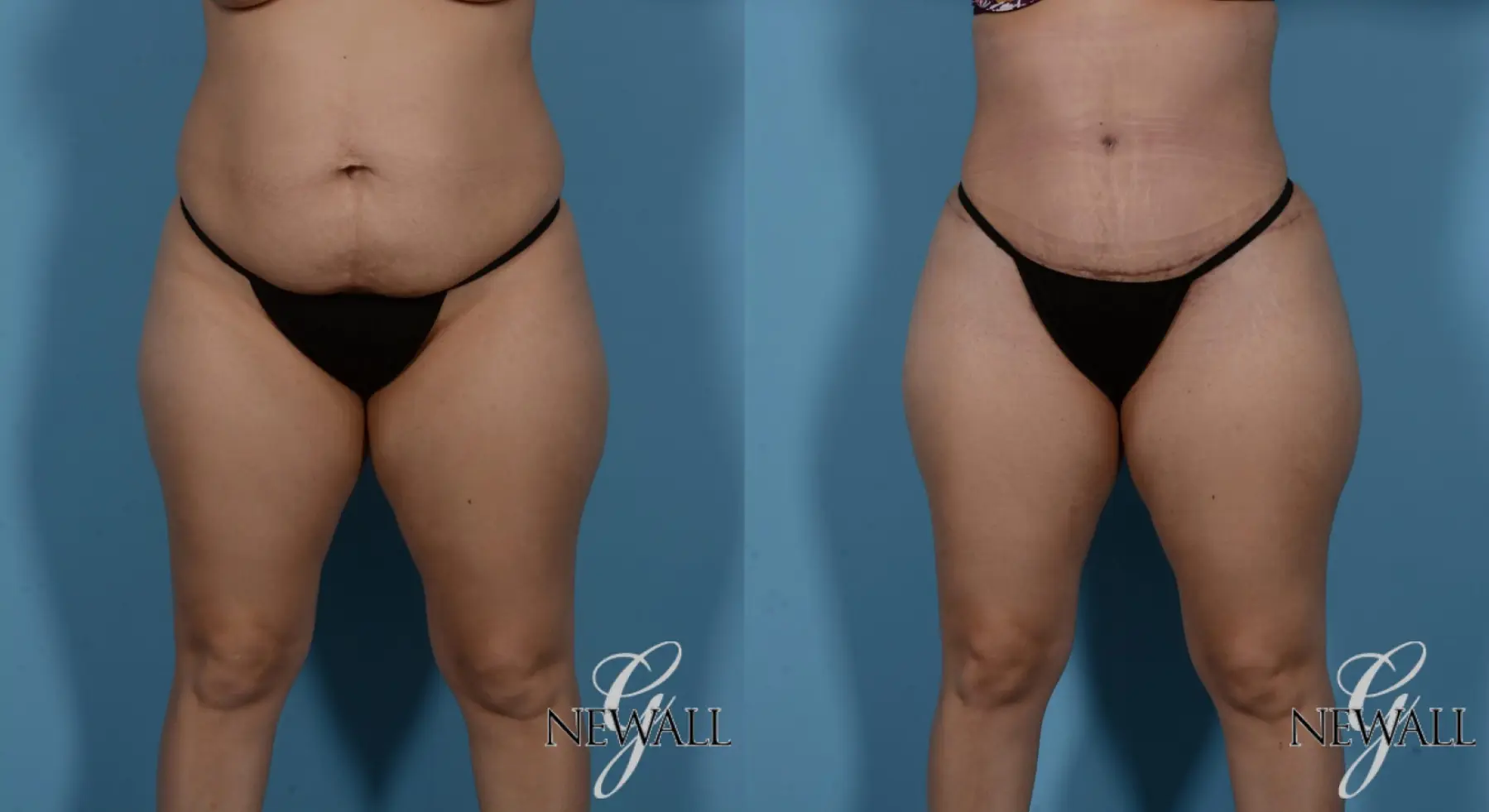 Tummy Tuck: Patient 2 - Before and After  