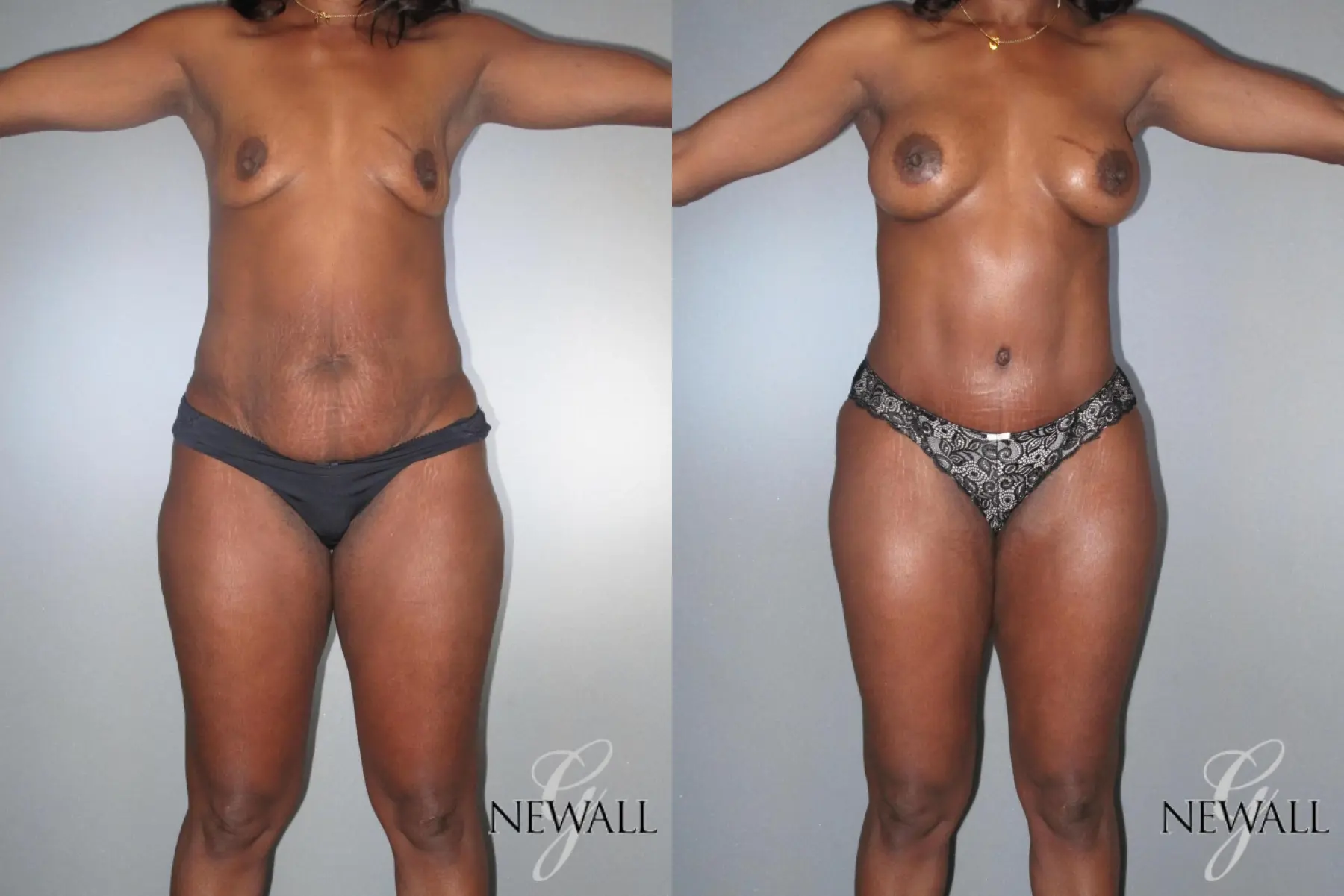 Tummy Tuck: Patient 9 - Before and After  