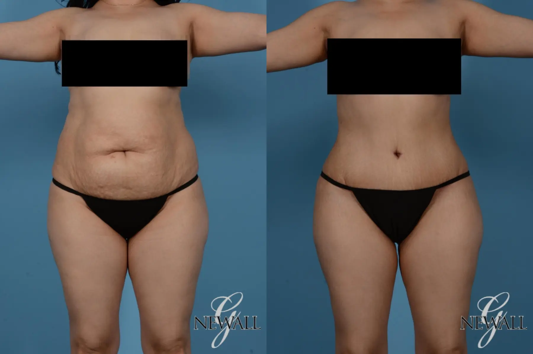 Tummy Tuck: Patient 11 - Before and After  