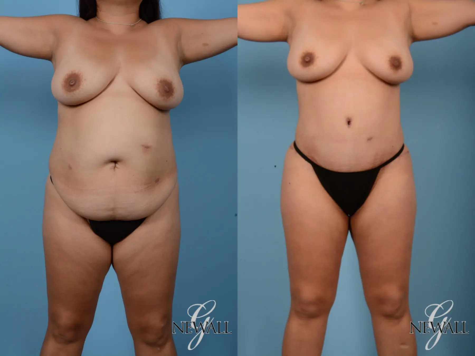 Tummy Tuck: Patient 6 - Before and After  