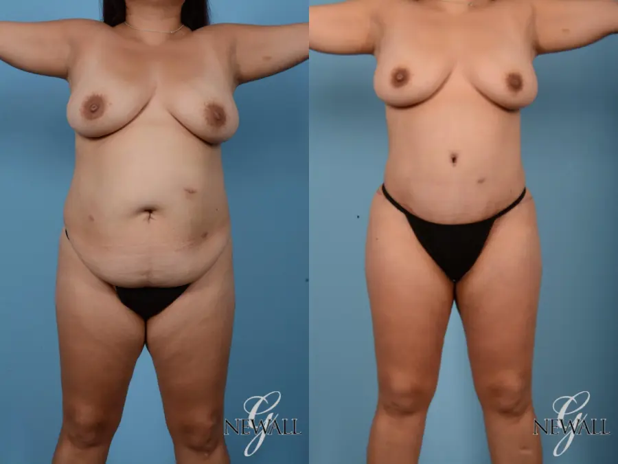 Tummy Tuck: Patient 6 - Before and After  