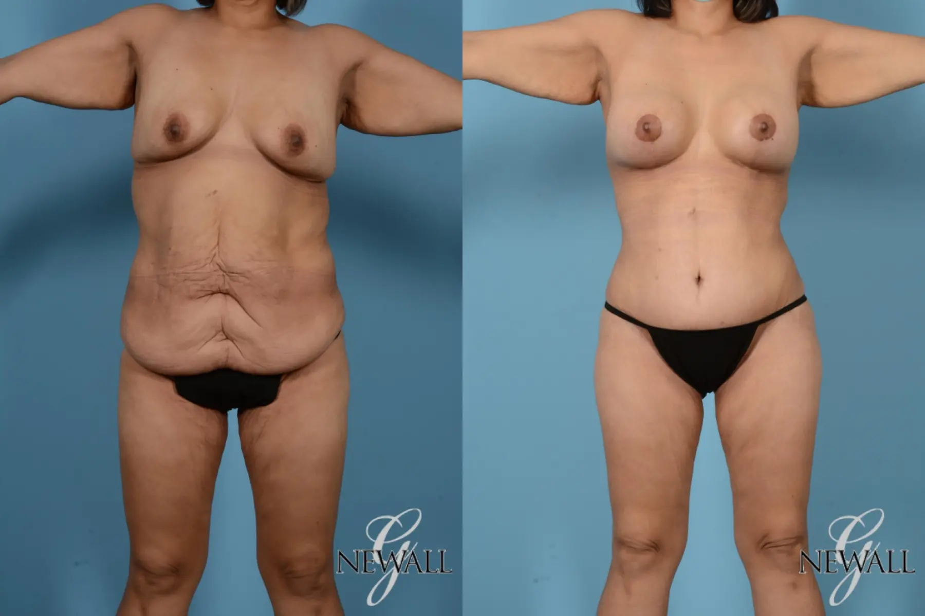 Tummy Tuck: Patient 13 - Before and After  