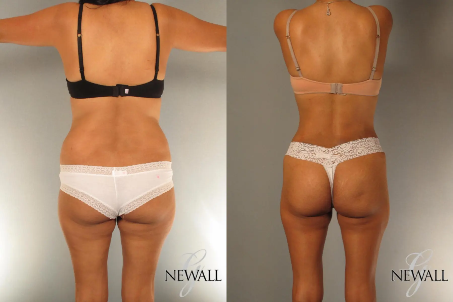 Tummy Tuck Before and After Photo Gallery, Albany & Latham, New York